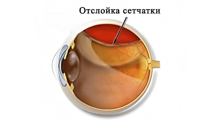 отслойка сетчатки глаза отслойка сетчатки глаза